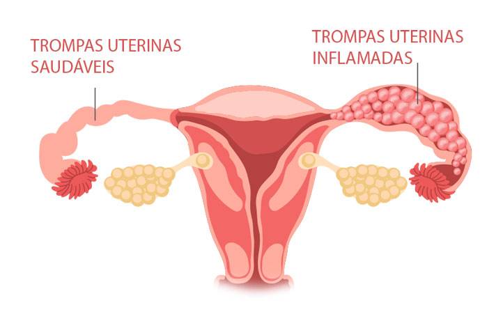 Hidrosalpinge e Infertilidade